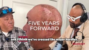 Life After Scarring Acne Folliculitis (Tufted Folliculitis) Five Years Later