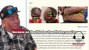 Beyond What Is Called Cosmetic Cicatricial Folliculitis and Folliculitis Decalvans | Robert's Story
