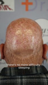 Life After Acne Keloidalis Nuchae (AKN) Removal | Robert’s Story