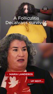 Is Scarring Alopecia Permanent? One Question. Two Lives