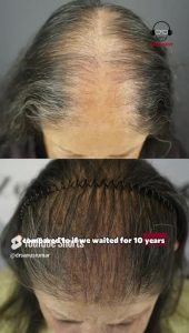 Dancing the Game of Life With Scalp Scarring and Hair Loss | Maria Chica’s Story