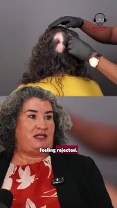 Crusting on Scalp and Folliculitis Decalvans: Rejection, Pain, and Feeling Alone | Maria Landeros