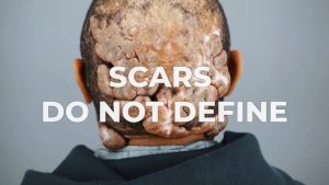 The Courage to Be Seen After Removal of Acne Keloidalis Nuchae and Folliculitis Decalvans