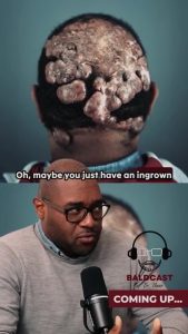 Misdiagnosed Scalp Condition | Anwar Baldcast Trailer
