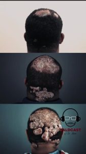 Painful scalp bumps with hair loss are not always simple folliculitis #scalphealth
