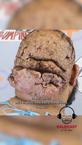 The Baldcast doesn’t just cover the surgery, it goes beyond #reels #shorts #podcast #explore #fy