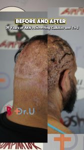 John's  AKN,  Dissecting Cellulitis, and CVG removed. Full Epsiode now on Youtube #akn #cvg #fyp #fy