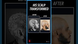 Painful Scalp Lumps Kept His Helmet Off. Look at Him Now