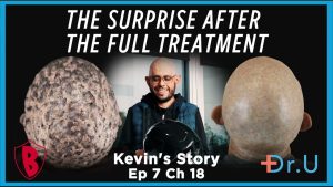 Painful Scalp Lumps and Hair Loss: His Transformation After Surgery