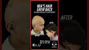 Don’t Give Up: A Parent’s Message on Pediatric Alopecia Areata