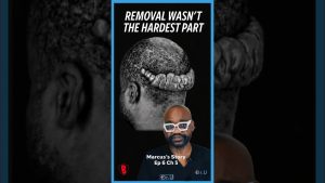 Severe Keloid Removal Surgery: Why Surgeons Hesitate