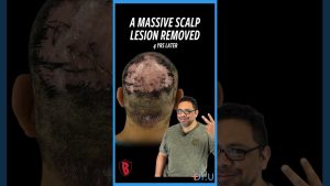 A Massive Scalp Lesion Removed. Did It Return 4 Years Later?