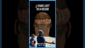 His Keloid Changed 3 Years of His Life | Marcus’ Story