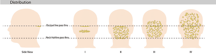 Diagram showing different AKN distribution spreads of discrete papular lesions across four different classes