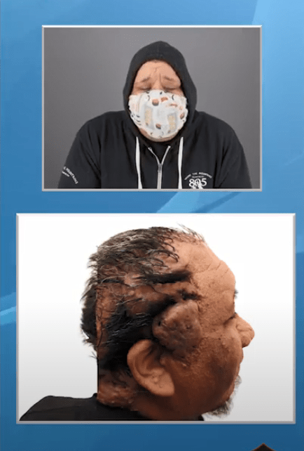 Scar tissue destroyed many of the hair follicles on this AKN patient's scalp 