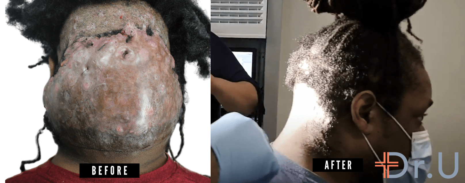 Before and after images showing patient's initial class III, tumorous mass presentation, compared to his final smooth appearance on the back of his head