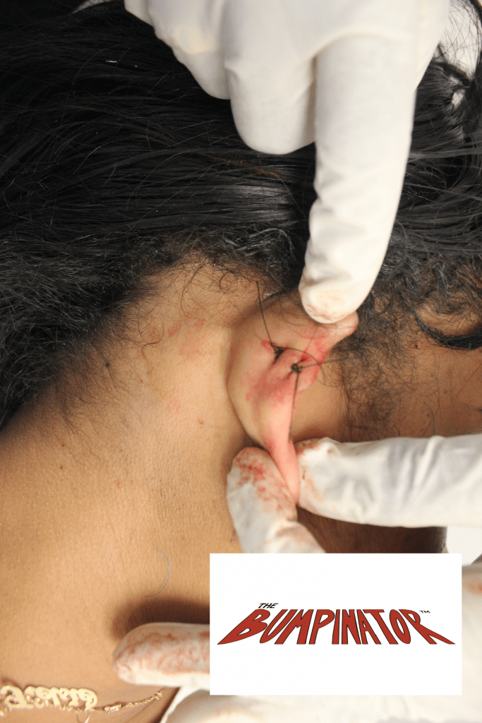 Now that Dr. Bumpinator has excised the patient's keloid, he is able to suture the resulting wound