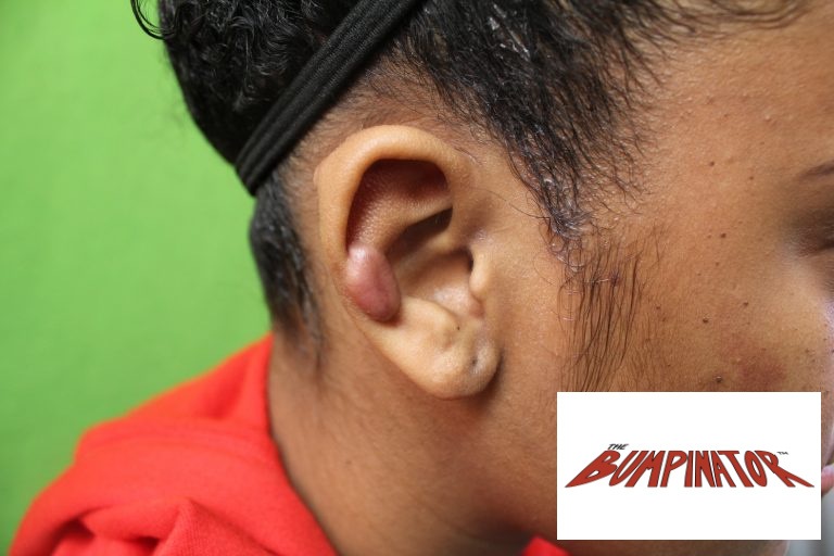 The patient’s right ear also had a keloid from a piercing.
