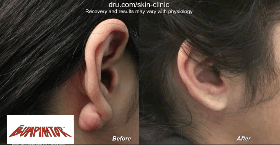 Keloid scar bumps on the earlobe can grow to be quite large. Dr.Bumpinator not only removes them, but also refashions the final earlobe to appear as natural-looking as possible. 