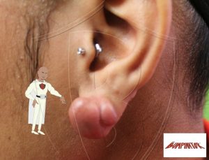 After previous surgery at another doctor, her left earlobe keloid returned larger.