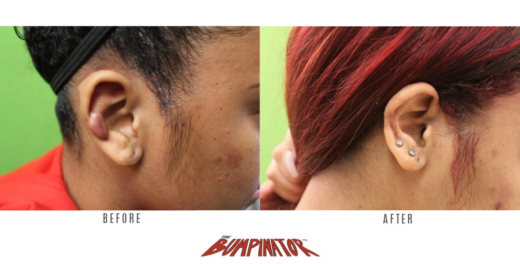 Before and after photos showing the original keloid bump on patient's right ear, as compared to her final healing results