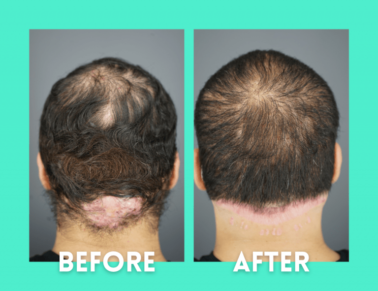 Witness One Man’s Journey in Getting Rid of Painful AKN Bumps