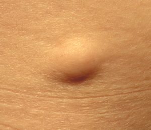Superficial lipoma on the skin