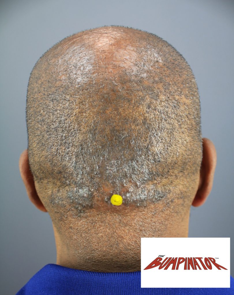 Type III AKN patient with merged papules and nodules, shown prior to Dr.Bumpinator's laser removal procedure. The yellow dot pinpoints the location of the patient's occipital notch