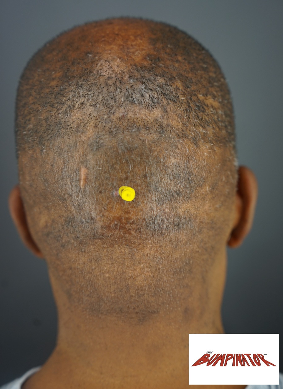 Type III AKN patient is shown after his laser treatment performed by Dr.Bumpinator