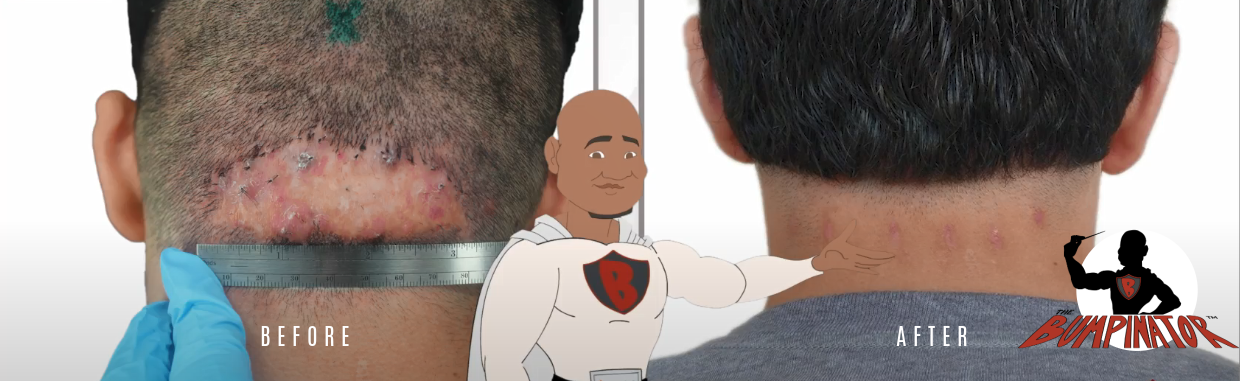 Military Shaved Head Requirements And Acne Keloidalis Nuchae