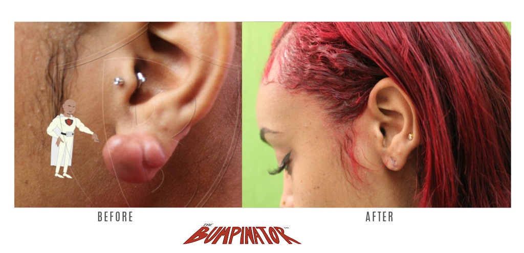 Massive earlobe keloid formation was successfully removed thanks to Dr.Bumpinator's removal. After photos show the exceptional restoration of patient's earlobe