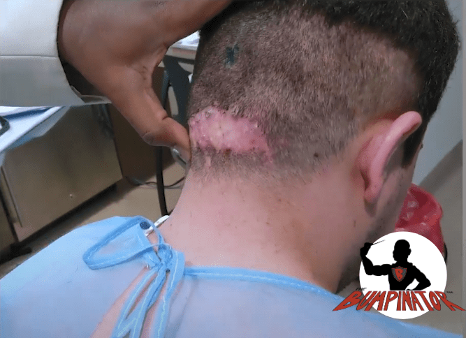 Dr. Bumpinator assesses the affected AKN region on the back of this patient's head