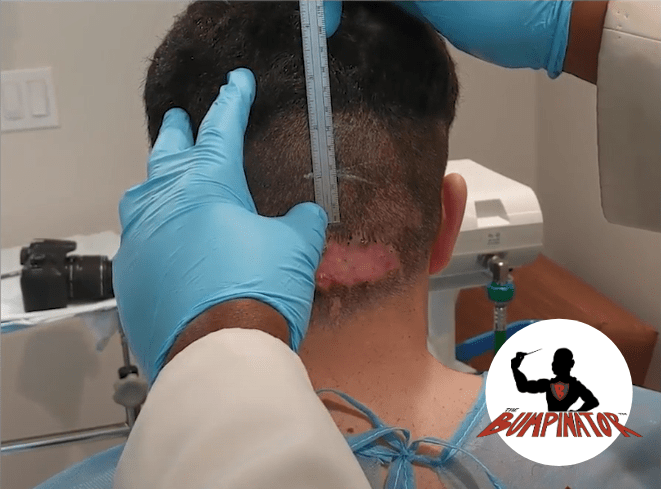 Measuring the AKN tissue, relative to scalp landmarks such as the occipital notch is an important step
