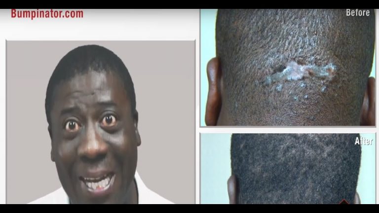 Can You Tell That This Man Had AKN Surgery? See His Final Scar Outcome